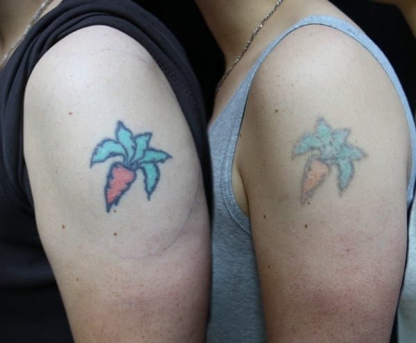 Laser tattoo removal Sydney #1 Best Pico Second Painless